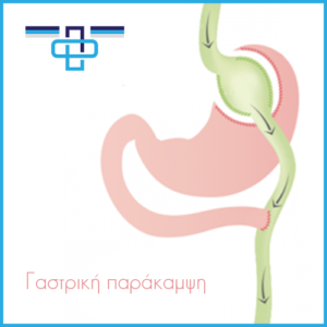 Πριν και μετά τη γαστρική παράκαμψη (γαστρικό bypass) 1