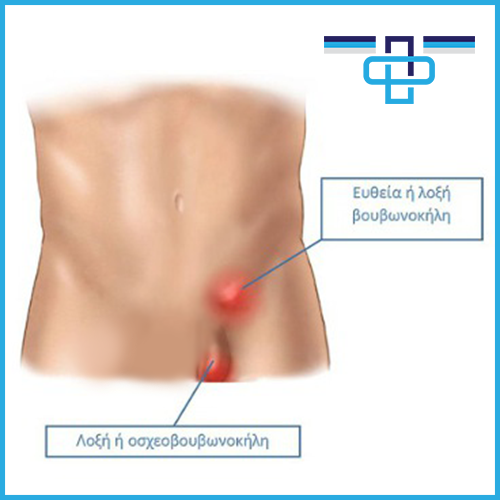 Βουβωνοκήλες και η αντιμετώπισή τους 1