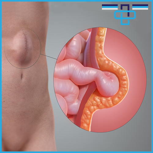 Πώς αντιμετωπίζεται λαπαροσκοπικά η μετεγχειρητική κήλη; 1