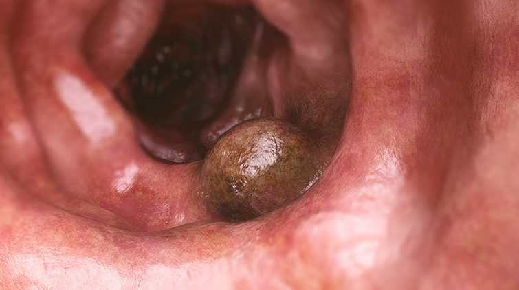 Καρκίνος Ορθού 1 Καρκίνος Ορθού