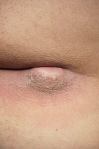 Κύστη Κόκκυγος