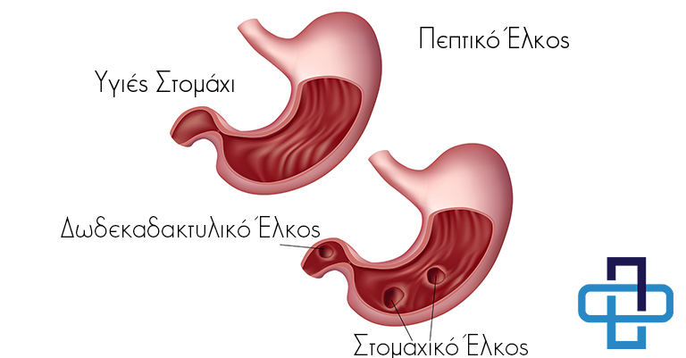 Πεπτικό Έλκος 1 Πεπτικό Έλκος