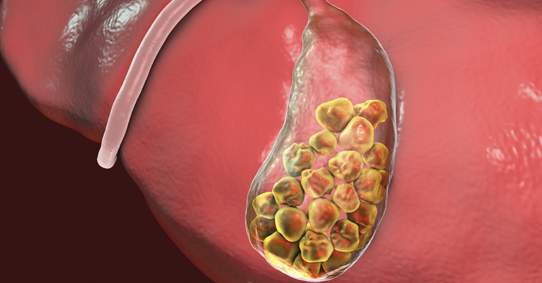 Πέτρες στη Χολή