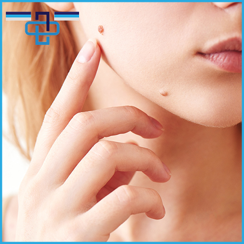 Σπίλοι - Πότε πρέπει να αφαιρούνται; 1