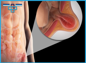 Γιατί Είναι Καλύτερη η Λαπαροσκοπική Αποκατάσταση της Βουβωνοκήλης από την Ανοικτή Μέθοδο; 15