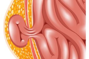 Ενδοσκοπική αποκατάσταση βουβωνοκήλης (TEP) 46