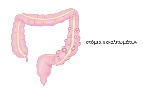 Εκκολπωμάτωση παχέος εντέρου