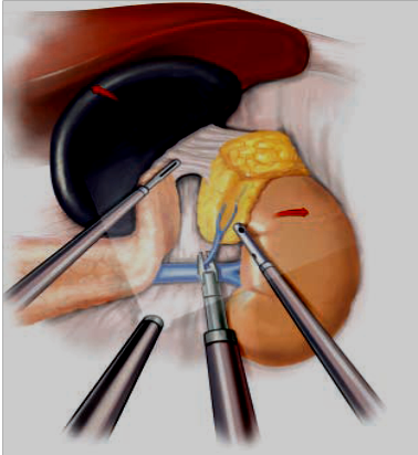 Χειρουργική επινεφριδίων 3 Χειρουργική επινεφριδίων 2
