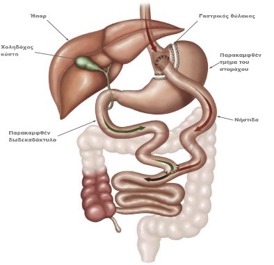 Επιμήκης γαστρεκτομή ή γαστρική παράκαμψη για την αντιμετώπιση της παχυσαρκίας; (sleeve gastrectomy Vs gastric bypass) 4 gastriki-parakampsi