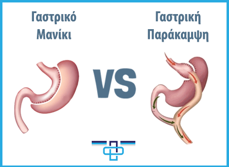 Επιμήκης γαστρεκτομή ή γαστρική παράκαμψη για την αντιμετώπιση της παχυσαρκίας; (sleeve gastrectomy Vs gastric bypass) 1