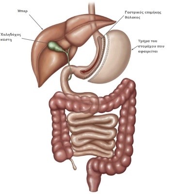 Επιμήκης γαστρεκτομή ή γαστρική παράκαμψη για την αντιμετώπιση της παχυσαρκίας; (sleeve gastrectomy Vs gastric bypass) 3 gastriko-maniki