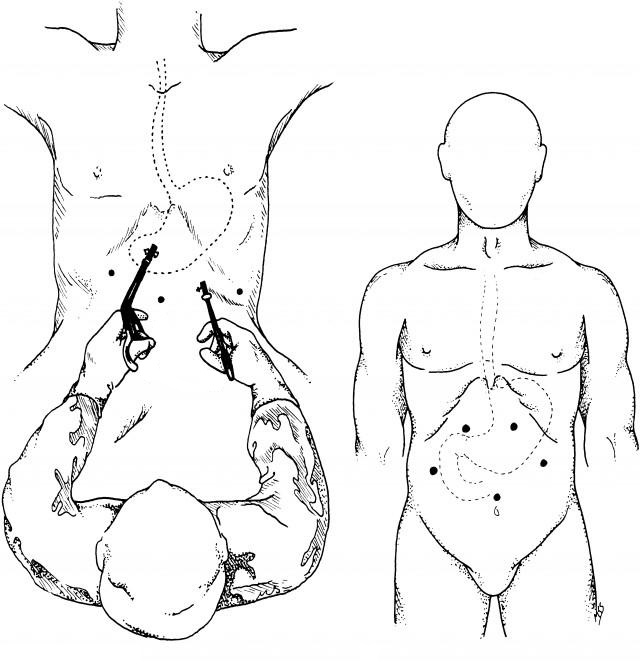 Γαστροοισοφαγική Παλινδρόμηση 2 Γαστροοισοφαγική Παλινδρόμηση