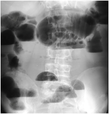 Χειρουργική λεπτού εντέρου
