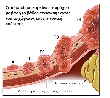 Καρκίνος στομάχου