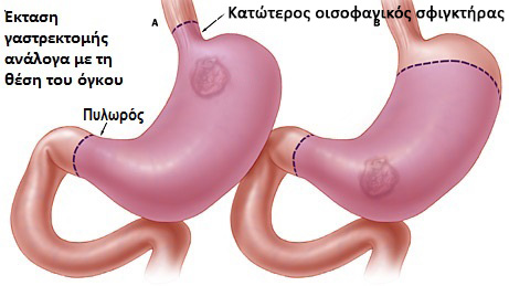 Καρκίνος στομάχου