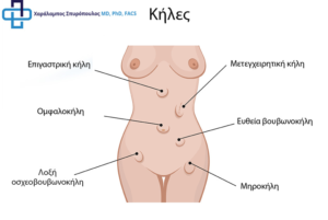 Κήλες: Ποιες είναι και πώς αντιμετωπίζονται; 42