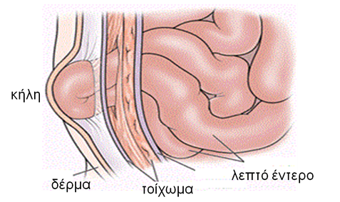 Χειρουργική Κηλών