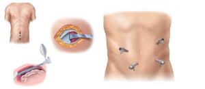 Λαπαροσκοπική χειρουργική αντιμετώπιση κηλών