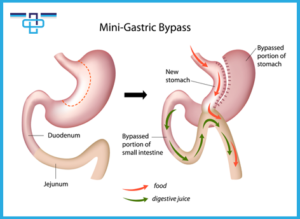 Γαστρική παράκαμψη μίας αναστόμωσης: η εξέλιξη των επεμβάσεων κατά της παχυσαρκίας και του σακχαρώδη διαβήτη 2 20