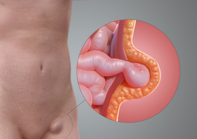 Femoral hernia 1 Femoral hernia