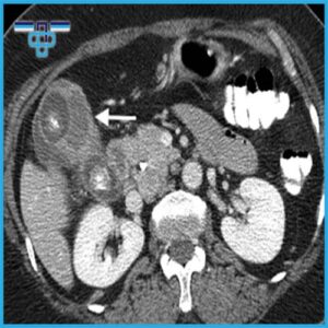 Καρκίνος Χοληδόχου Κύστης: Μία ύπουλη και επιθετική κακοήθεια που μπορεί συνήθως να προληφθεί 13