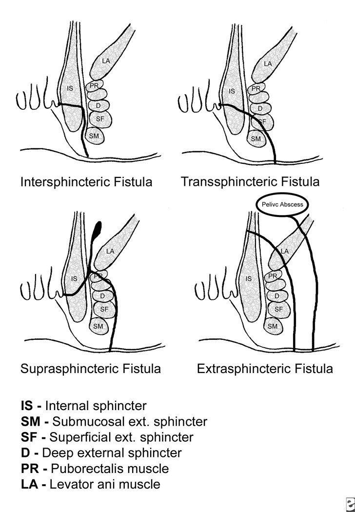 Περιεδρικό Συρίγγιο 1