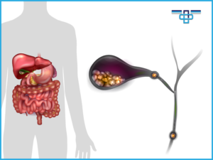 Πέτρα στη Χοληδόχο Κύστη («Χολή») χωρίς Συμπτώματα: Πρέπει να Χειρουργηθώ; 21