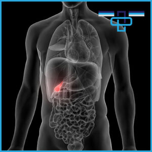 Πολύποδες Χολής (χοληδόχου κύστης): Πώς αντιμετωπίζονται; 52