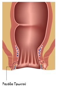 Ραγάδα Δακτυλίου