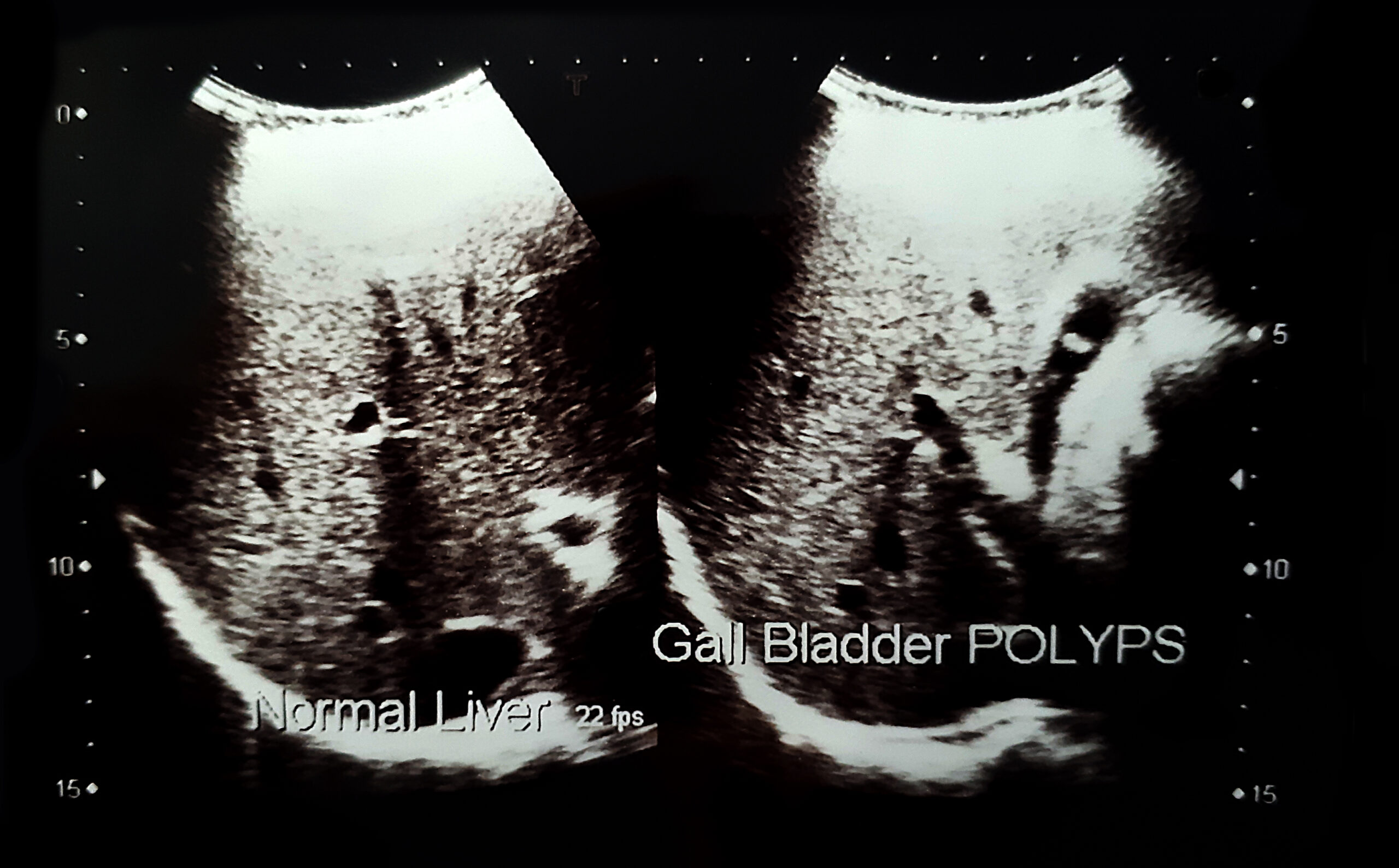 Πολύποδες στη Χολή