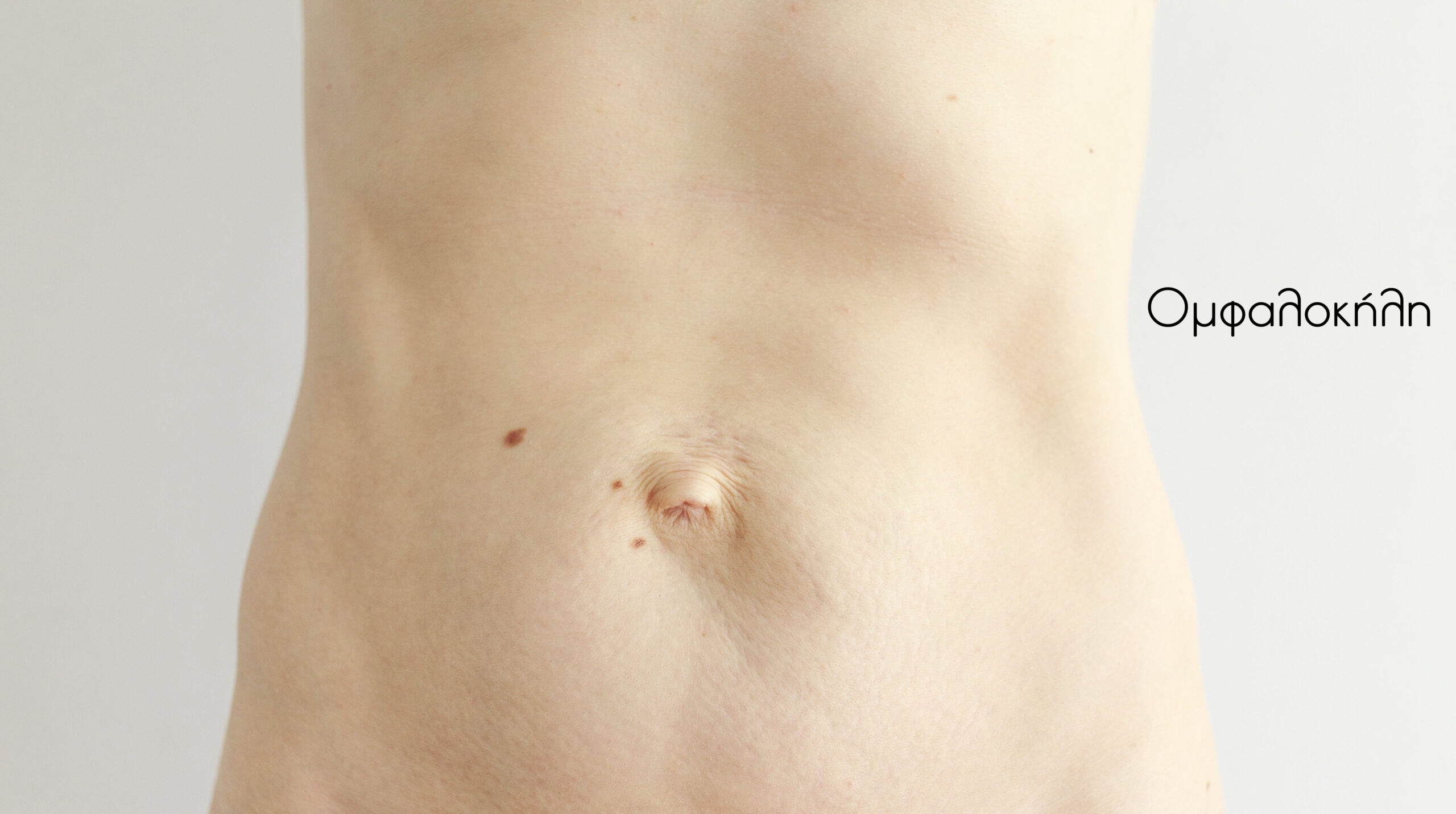 Ομφαλοκήλη