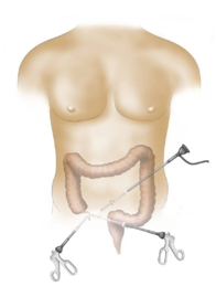 Σκωληκοειδίτιδα