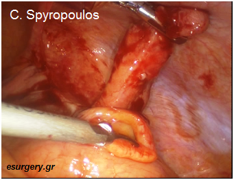 Σκωληκοειδίτιδα