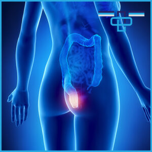 Αιμορροΐδες: Η συχνή και ενοχλητική νόσος 50