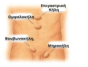 Χειρουργική Κηλών