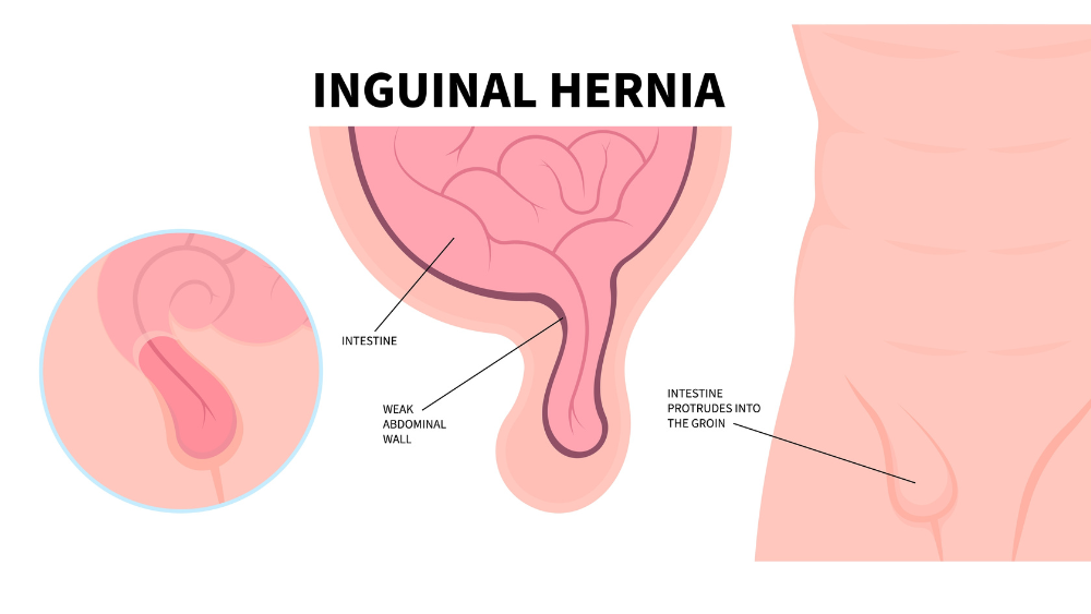 Βουβωνοκήλη Κίνδυνοι και πιθανές επιπλοκές 1