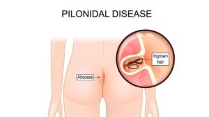 Κύστη Κόκκυγος: Σε ποιο γιατρό να απευθυνθώ ; 17