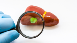 Έχω πολύποδα στη χολή μου; Τι κάνω; 5