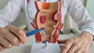 Δυσκοιλιότητα & Αιμορροΐδική Nόσος 13