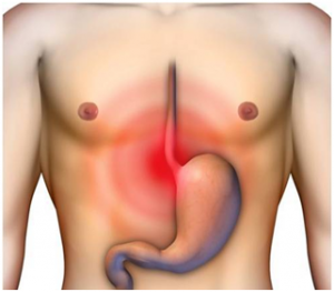 Γαστροοισοφαγική Παλινδρόμηση