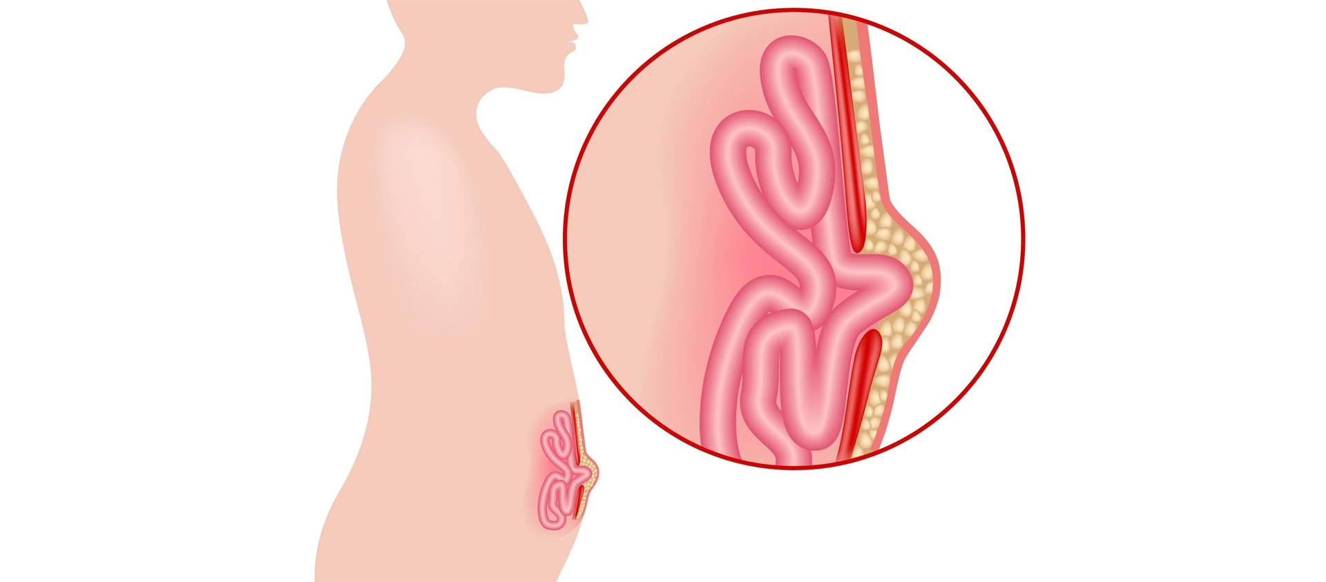 Κοιλιοκήλη 1 Κοιλιοκήλη