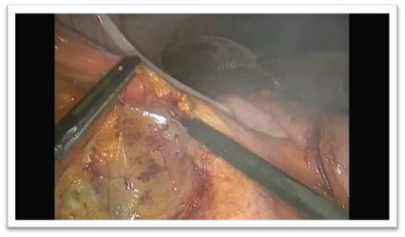 Λαπαροσκοπική Κολεκτομή 