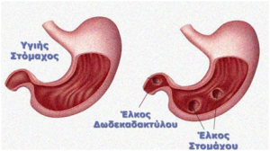 Πεπτικό Έλκος 2 Πεπτικό Έλκος