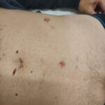 Βουβωνοκήλη: Αίτια, Θεραπεία, Κόστος και Σύγχρονες Τεχνικές 9