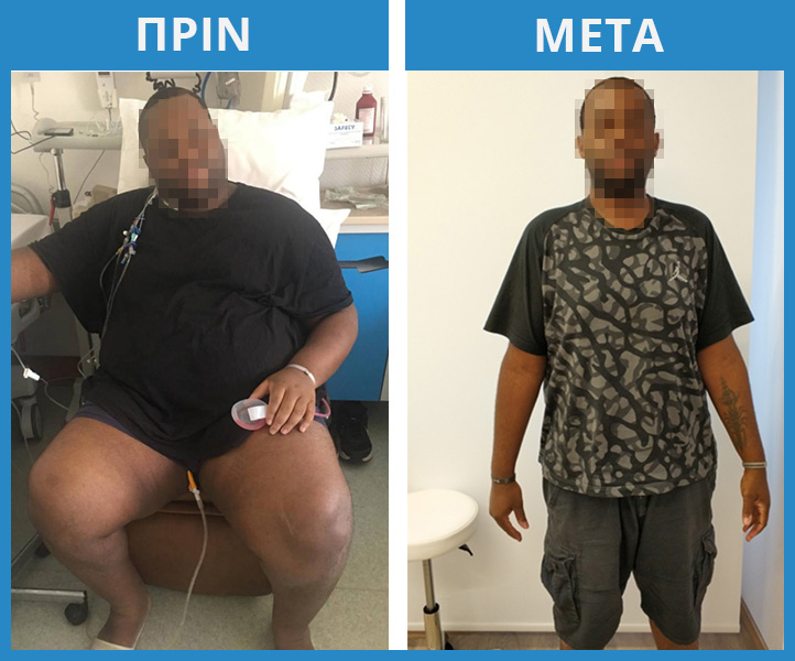Χειρουργική Παχυσαρκίας 18 Χειρουργική Παχυσαρκίας 17