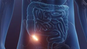 Σκωληκοειδίτιδα, τα πρώτα συμπτώματα 19