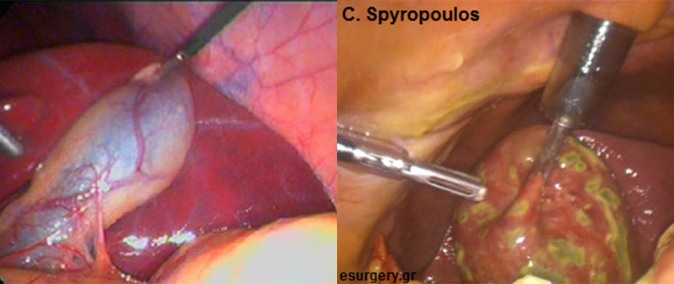 Παθήσεις Χολής 13